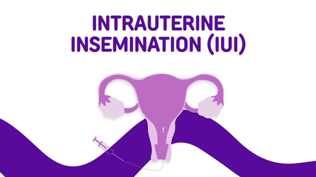 Best IUI Treatment in Hyderabad