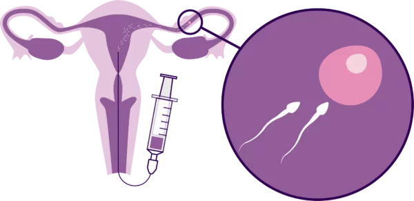 iui tretment in hydrabad